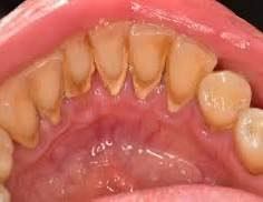 السلام عليكم 
العنده تكلسات مثل الصورة يراسلني واتساب 
العلاج مجاني 
عالرقم 
***********
