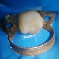 حشوة تجميلية • الضرس السادس علوي • القياره