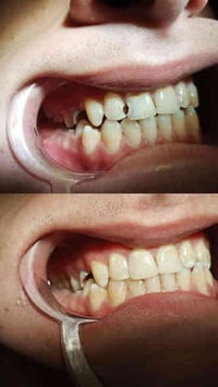 حشوة ضوئية • جلسة واحدة • الرفاعي شارع الاطباء