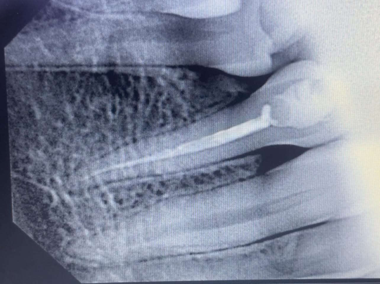 حشوة جذر للسن الخلفي
طبيب الاسنان الاختصاص د.عمار عباس
ماجستير تقويم وتجميل الاسنان M.S.c ortho
بكلوريوس طب وجراحة الفم والأسنان B.D.S
بغداد الشعب شارع عدن قرب  مركز شرطة الشعب  مدخل سوق شلال عمارة باريس الطابق الاول دوام العيادة جميع ايام الاسبوع ما عدا الجمعة عطلة من ٤ ل ٨  بدون حجز مسبق الدخول حسب اسبقية الحضور للعيادة الفحص والمعاينة مجاني للاستفسار ***********
