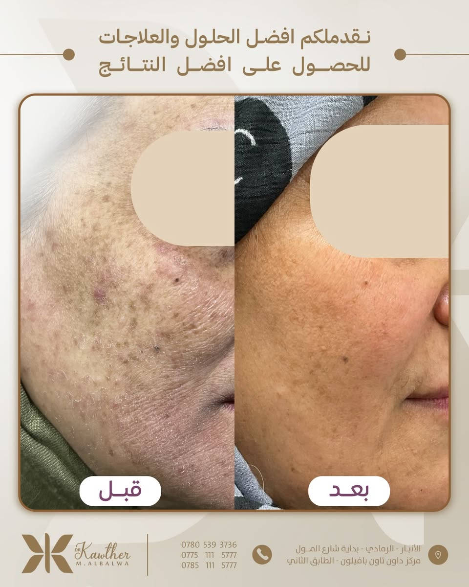 معالجة العديد من الحالات الجلدية ♥️
نحرص دائماً على تقديم رعاية متكاملة وشاملة لمختلف الحالات الجلدية، باستخدام أحدث التقنيات الطبية 🤎😍
•••••
العنوان📍: الأنبـار - الرمادي - بداية شارع المــول - مركز داون تاون بافيلون - الطابق الثاني
📱 للحجز والاستفسار الأتصال على:
📞 ***********
📞 ***********
📞 ***********

#عيادة_الدكتورة_كوثر_البلوة #جلدية #تجميل #ليزر
