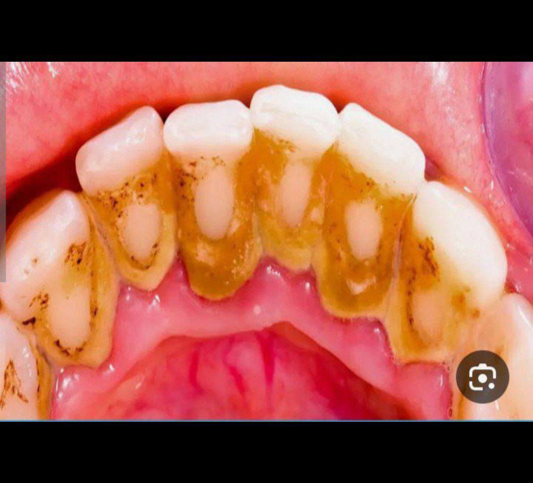 السلام عليكم متوفر علاج أسنان مجاني الي يعاني من تسوس  ، الي محتاج تخم كامل للتعويض الاسنان المفقودة ، تنظيف التكلسات وازالة التصبغات ، معالجة البقع البيضات والالتهابات التي تحصل بالفم ، حشوات وتنظيف خاصة للأطفال ،  قلع الجذور ,تقويم الاسنان لجميع الاعمار .
يمكنكم التواصل عل الرقم 
*********** 
عيادات طب الاسنان جامعة الكوفه-  
علماً ان العلاج مجاني بإشراف اطباء مختصين
