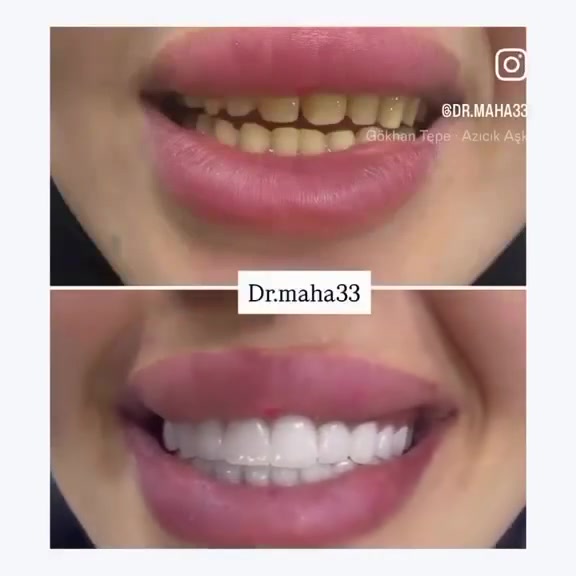 ابتسامة فينير ايماكس 🦷♥️

ابتسامة هوليود للفكين ايماكس وبلون ابيض طبيعي 
.
.
.
عنوان العيادة 🦷🤍✨

الرمادي _شارع المستودع _مجمع زهرة اليقطين مبنى الضريبة القديمه نفسها قرب كراج التاميم 
 

للحجز والاستفسار الاتصال ع الرقم: ***********
او مراسلة صفحة العيادة 

أوقات الدوام من الساعة من ١١ صباحاإلى الساعة ٩ ليلا
