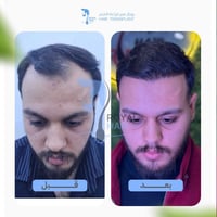 زراعة شعر ٥ أشهر • المنصور شارع الاميرات • بناية جود ط٢