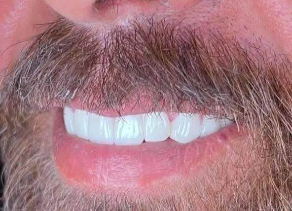 تم إعادة الابتسامة الجميلة لمراجعنا العزيز بعد معالجة الأسنان بحشوات الجذر وتعويض الأسنان المفقودة وتغليف باقي الاسنان بتركيبات الزيركون 
العنوان ميسان الماجدية شارع الملعب خلف مركز الشرطة أمام جامع الثقلين للحجز والاستفسار 
***********
عيادة البتول لطب الاسنان عمارة, ميسان
