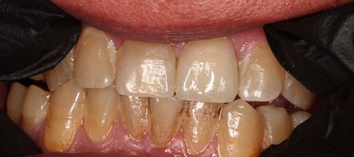 📍 العنوان: خانقين / تولةفروش / مقابل مسبح مرواري

🦷 الحالة العلاجية:
إعادة بناء وترميم الأسنان الأمامية المتضررة باستخدام حشوات تجميلية، مع استعادة الشكل الطبيعي للأسنان، وتحسين الإطباق، وإرجاع جمال الابتسامة ووظيفتها.

📍 عيادة الدكتور محمد خداداد

نستقبلكم بكل حب لتقديم أفضل خدمات طب وتجميل الأسنان:

🦷 حشوات الأسنان (العلاجية والتجميلية)
🦷 تنظيف وتبييض الأسنان
✨ تيجان وجسور الأسنان (التعويضية والتجميلية)
🌱 زراعة الأسنان بأحدث التقنيات
😁 تصميم ابتسامة هوليوود
🩺 قلع الأسنان والجراحة البسيطة
👶 طب أسنان الأطفال
🦷 علاج عصب الأسنان

📞 للحجز والاستفسار: ***********  

📍 العنوان: خانقين / تولةفروش / مقابل مسبح مرواري
