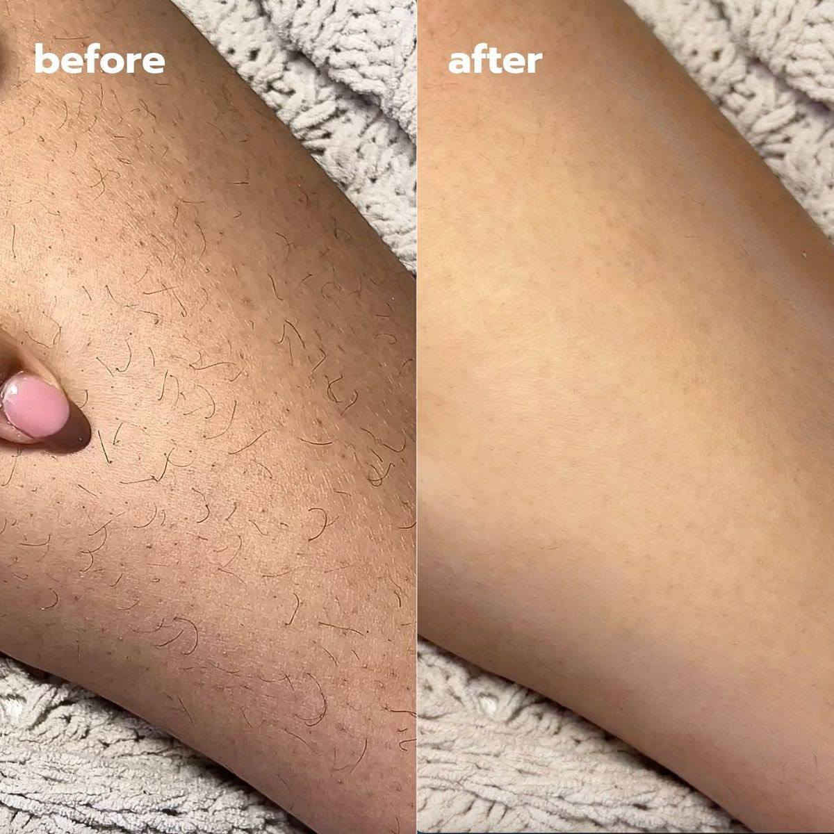 IPL HAIR REMOVAL DEVICE 
الليزر الرهيب 😍 و سعره جداااا مناسب 
تألقي ببشرة صافية ولامعة!
تمتعي ببشرة نظيفة وناعمة دون الحاجة لزيارة مراكز التجميل وإزالة الشعر، مع جهاز ليزر IPL المنزلي لإزالة الشعر بالليزر.
وميض مكثف وهي IPL جهاز سلكي مزود بطاقة , لا يحتوي على بطارية بداخله يعتمد على تقنية حديثة لإزالة الشعر بشكل دائم.
احدت تقنية أجهزة الليزر 💯💯

المواصفات و المميزات:
يأتي بعدسة أساسية مصممه لكامل الجسم
يحتوي على مليون ومضة تكفي لأكثر من 10 سنوات
 خمسة درجات تناسب جميع البشرة باستثناء الداكنة جداً 
 ومضات تلقائية عند الضغط على زر التشغيل الومضات من 3-5 ثوان يتحول لنظام التلقائي 
جهاز غير مؤلم 100% ولا يحتاج إلى خاصية التبريد بعد الاستعمال
الجهاز خفيف و سهل الاستخدام والتنقل لصغر حجمه.

- طريقة الاستخدام 💯💯
قومي بحلق المنطقة المراد إزالة الشعر منها وتنظيفها بشكل كامل قبل استخدام الجهاز بيوم .
 في يوم الجلسة يجب ان تكون البشرة نظيفة خالية من اي نوع من الكريمات والعطور وعدم استخدام اي منها قبل او بعد الجلسة
ابدئي بتنظيف وتعقيم شاشة الومضات برفق باستخدام قطعة قطن.
ثم وصلي سلك الطاقة في المقبس الكهربائي.
اختاري المستوى المناسب الذي يمكن أن تتحمله بشرتك.
ضعي شاشة الومضات على بشرتك بشكل عمودي مباشر ثم قومي بالضغط بعد ذلك سيتحول النظام الى تلقائي
الالوان التي تناسب الجهاز
💯 ملحقات الجهاز شفرة + نظارة واقيه من الاشعه 

السعر 77 الف فقط**
🔴 فقط الكم بهذا السعر اقل سعر بالعراق بسعر الجملة
🚘 يوجد خدمة توصيل لجميع محافظات العراق ٤ الاف 🚘


**إذا كنت صاحب هذا الإعلان وتريد حذفه لأي سبب، رجاءا أرسل رسالة إلى الدعم الفني**