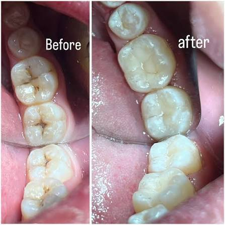 السلام عليكم نعلن عن توفير علاج للاسنان مجاني فقط لفترة اسبوع بعد العيد مباشرتا سارع في حجز موعدتك حشوات تنظيف قلع 
مجاني 
العنوان شارع فلسطين عيادات جامعه المصطفى خلف الجامعة المستنصرية قرب تقاطع الموال للحجز راسلونا على ***********
