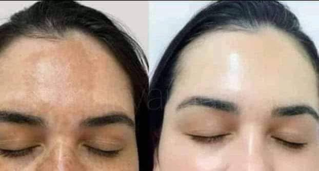 كريم سيفيك ليمون (Civic Lemon Cream)، وهو كريم لتفتيح البشرة ومعالجة بعض مشاكل الجلد. الإيطالية🇮🇹 

✅يحتوي على مستخلص الليمون الغني بفيتامين ج للمساعدة في تفتيح البشرة. 

✅يساعد على ترطيب البشرة وتنعيمها والحفاظ على مرونتها. 

✅يُستخدم للمساعدة في تلاشي البقع الداكنة وعيوب البشرة وتوحيد لونها. 

✅يحتوي على مكونات نشطة مثل كلوبيتاسول بروبيونات (Clobetasol Propionate) بنسبة 0.05%، وهو كورتيكوستيرويد قوي لعلاج حالات جلدية معينة مثل الأكزيما والصدفية. 
المنشأ إيطاليا الأصلي 🇮🇹 ✅

السعر خاص


**إذا كنت صاحب هذا الإعلان وتريد حذفه لأي سبب، رجاءا أرسل رسالة إلى الدعم الفني**