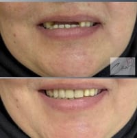 اي شخص عنده فقدان باسنانه مثل الحالات الي ناشرتهم جوه وسواء ان كان  ال...