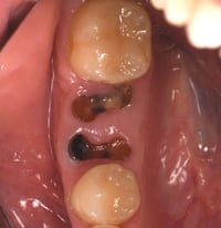 الي عنده بقايا جذور او، اسنان منتهيه ويريد يقلعها يتواصل 07802796885 و...