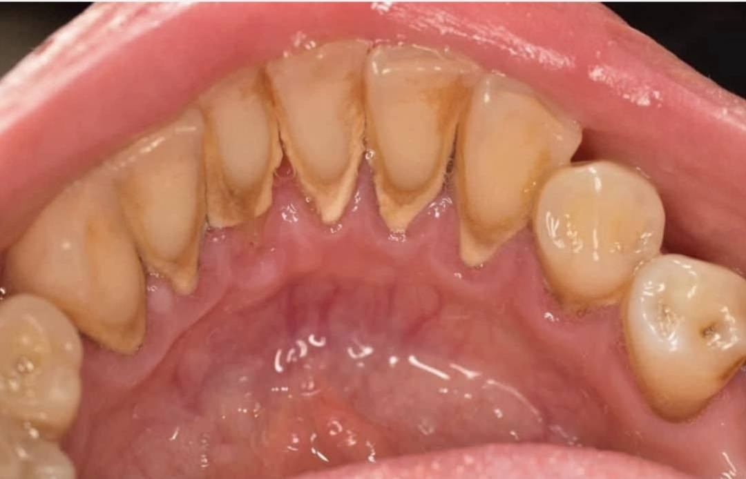 مجاناااا
الي عنده تكلسات باسنانه مثل الي بالصورة ويريد تنظيف لاسنانه يتواصل وياي ع خاص او يتصل على الرقم ***********
شارع 40 مجاور صيدلية سلامتك 
(العلاج مجاني)
