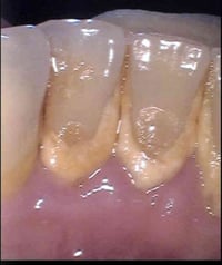 تنظيف اسنان • مجاني • عيادات جامعه العميد