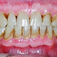 تنظيف اسنان • علاج مجاني • كربلاء الحر الصغير