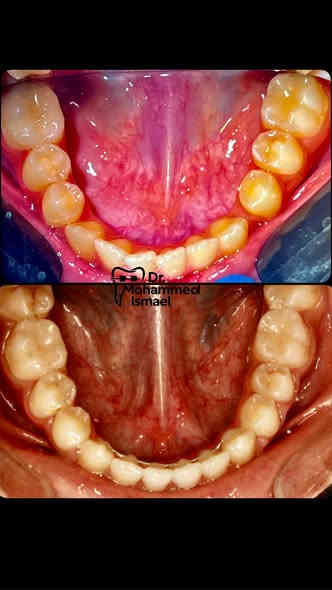 يسرنا اعلامكم بتواجد
الدكتور محمد اسماعيل المشهداني
اخصائي تقويم الاسنان
نقدم لكم خدمات تقويم الاسنان المعدني والشفاف وزراعة الاسنان (بأحدث الانظمة وبالتقسيط )
،
حشوات تجميلية، حشوات جذور، وقلع جراحي

العنوان: الخالدية-شارع عشرين- مجمع الطائف الطبي
للحجز والاستفسار: 
يمكنكم التواصل عبر الواتساب او الاتصال على الرقم:👇
                          📞 ***********
،

لمشاهدة الحالات التي تم علاجها زورونا على صفحة العيادة
https://www.facebook.com/share/1Do88FgLBa/?mibextid=wwXIfr
،
(كتب الله لكم السلامة والعافية من كل مرض)
