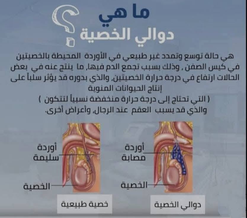 العقم الرجالي (عدم القدرة على الانجاب) من بين الامراض التي بدأت بالانتشار في مجتمعنا. 
دوالي الخصية هي الأولى من بين أسباب العقم التي يمكن علاجها. 
من بين الرجال المصابين بمشكلات في الخصوبة 40% تقريبًا مصابون بدوالي الخصية. 
ازالة الدوالي بالناظور الجراحي هو الحل الامثل. 
 

للاستفسار يمكنكم التواصل على الرقم / واتس اب 
***********
***********
***********

المحمودية شارع الاطباء مجاور حسينية بيت النجار مقابل اسواق دار النجار مجاور صيدلية النبض  مجاور مختبر الفا بلس قرب المختبر الدولي للتحليلات المرضية

#المحمودية
#المحموديه
#مجمعات
#مجمعات_طبية 
#اكسبلور 
#اكسبلور_فولو
