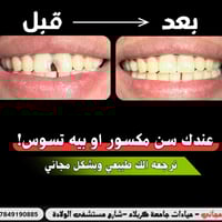 حشوات أسنان مجانية • عيادات جامعة كربلاء