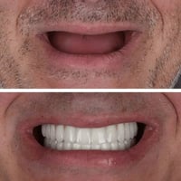 الي فاقد كل أسنانة ويريد يعوضهم مجانا يتواصل على الخاص للحجز أو على ال...