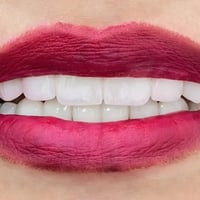 ابتسامة هوليود • تجميل أسنان • واسط بدرة