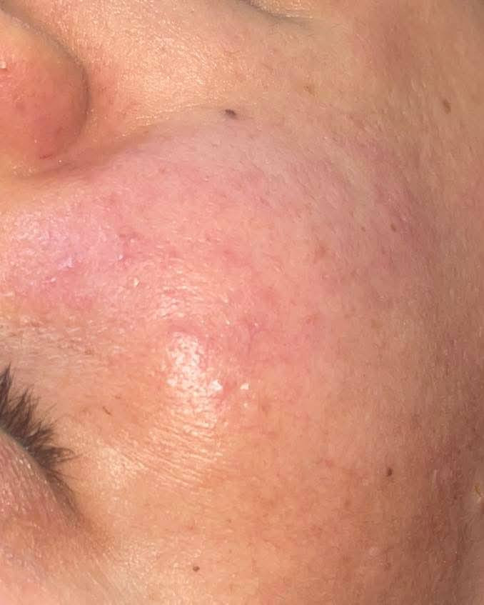 ⸻

✨ خلي بشرتچ تبدي صفحة جديدة… ✨
مو بس تنظيف، جلسة تعيد لبشرتچ هدوءها ولمعتها الطبيعية.

💠 نفتح المسام ونخلّيها تتنفس
💠 نزيل التراكمات اللي تعبت بشرتك
💠 لمسة ترطيب تخلي وجهك يلمع بدون فلاتر
💠 إحساس خفّة وراحة يبان من أول نظرة

جلسة صغيرة… فرق كبير.
📩 للحجز: راسلينا وخلي نضارة وجهچ ترجع تحچي عنچ بنفسها 
📍 العنوان: المدحتية / الجمعية مقابل أسواق حاتم للتسوق المنزلي
📞 الحجز: ***********
