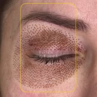 جلسات شد البشره وازاله التصبغات بتقنية جديده  للحجز او الاستفسار واتس ...