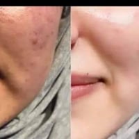 خلطة وجه • نمش • خلال يومين