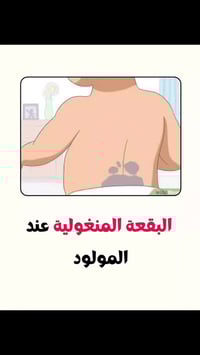 #البقعة_المنغولية_عند_الرضع  د.ياسر الزيادي إختصاص طب الأطفال وحديثي ا...