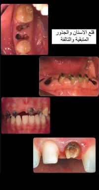 قلع أسنان مجاني • جذور متبقية • جامعة الفراهيدي