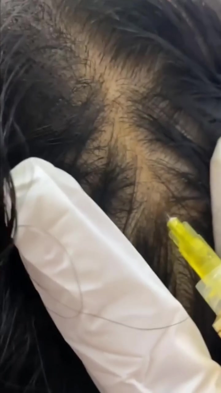 ✨ DQ Hair+ الفرنسي ✨
إذا تعانين من تساقط الشعر أو الفراغات، فـ DQ Hair+ يعد من كوكتيلات الميزوثيرابي المخصصة لدعم صحة الشعر، إذ يحتوي على مزيج من فيتامينات B والمعادن المغذية التي تساعد على تنشيط البصيلات وتحسين الدورة الدموية في فروة الرأس، مما يساهم في تقليل التساقط وتحفيز نمو شعر أقوى وأكثر كثافة.

💉 يُستخدم بالميزوثيرابي أو مع الديرما بن.
🌱 مناسب للرجال والنساء.
📈 يساعد على تحسين مظهر وكثافة الشعر تدريجياً مع الالتزام بالجلسات الموصى بها.

شعر صحي يبدأ ببصيلات قوية. ✨�
(مركز اريا سنتر )
الكاظميه/ الطي/ قرب ماكس كيك
للتواصل ***********
