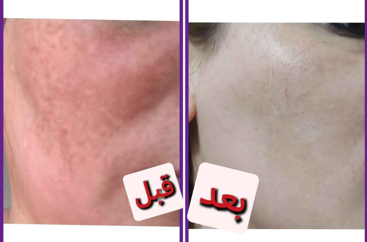 فوائد الخلطه
تفتيح لون البشرة وتوحيدها، مكافحة البقع الداكنة وعلامات الشيخوخة المبكرة، وتقشير البشرة بلطف وإزالة خلايا الجلد الميتة. كما يعمل على تهدئة البشرة وتوفيرها بالفيتامينات اللازمة للحفاظ على صحتها ونضارتها، وله خصائص تمنع ظهور حب الشباب. حلة, بابل


**إذا كنت صاحب هذا الإعلان وتريد حذفه لأي سبب، رجاءا أرسل رسالة إلى الدعم الفني**