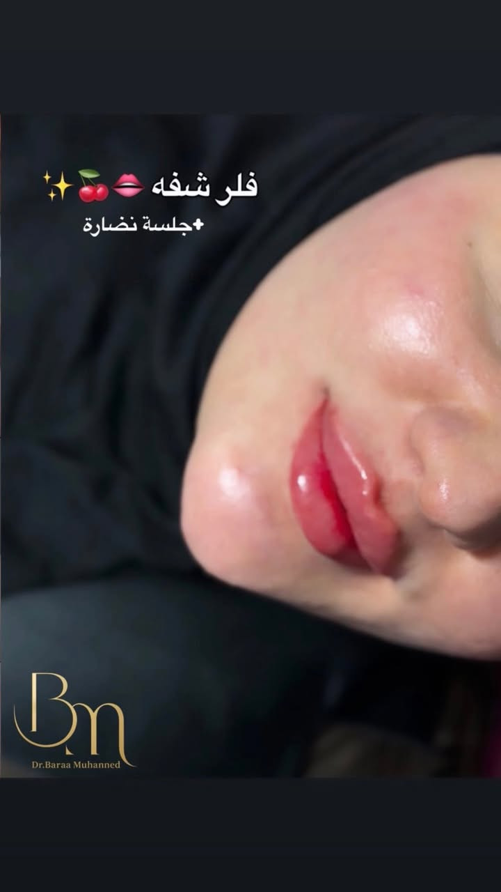 مع كثرة عيادات التجميل تتميز الدكتورة براء السوداني بنظافة وجمال الشغل عنوان العيادة شارع الاطباء قرب السوق الصغير مجاور مركز السفير داخل عيادة فيروز 
للحجز السريع او الاستفسار واتساب ***********
