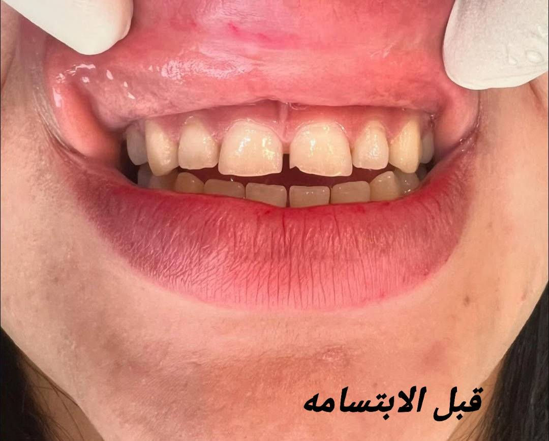 ✨ عروض العيد لتعديل الابتسامة ✨
عيادة دكتوره الدكتورة هند الحسيني 
خلي ابتسامتكم أحلى بهالعيد 😍🦷
🎀 تبييض الأسنان بالليزر
🎀 سد الفراغات بالحشوات التجميلية
🎀 تنظيف وتلميع الأسنان
🎀 ابتسامة دايركت فينير بدون برد
ابتسامة مرتبة وطبيعية من أول جلسة ✨
📩 للحجز والاستفسار مراسلة خاص
او على الرقم ***********
📍الحجز مسبق والأماكن محدودة
@إشارة
