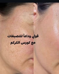 كورس الكركم • يزيل حب الشباب • توحيد لون
