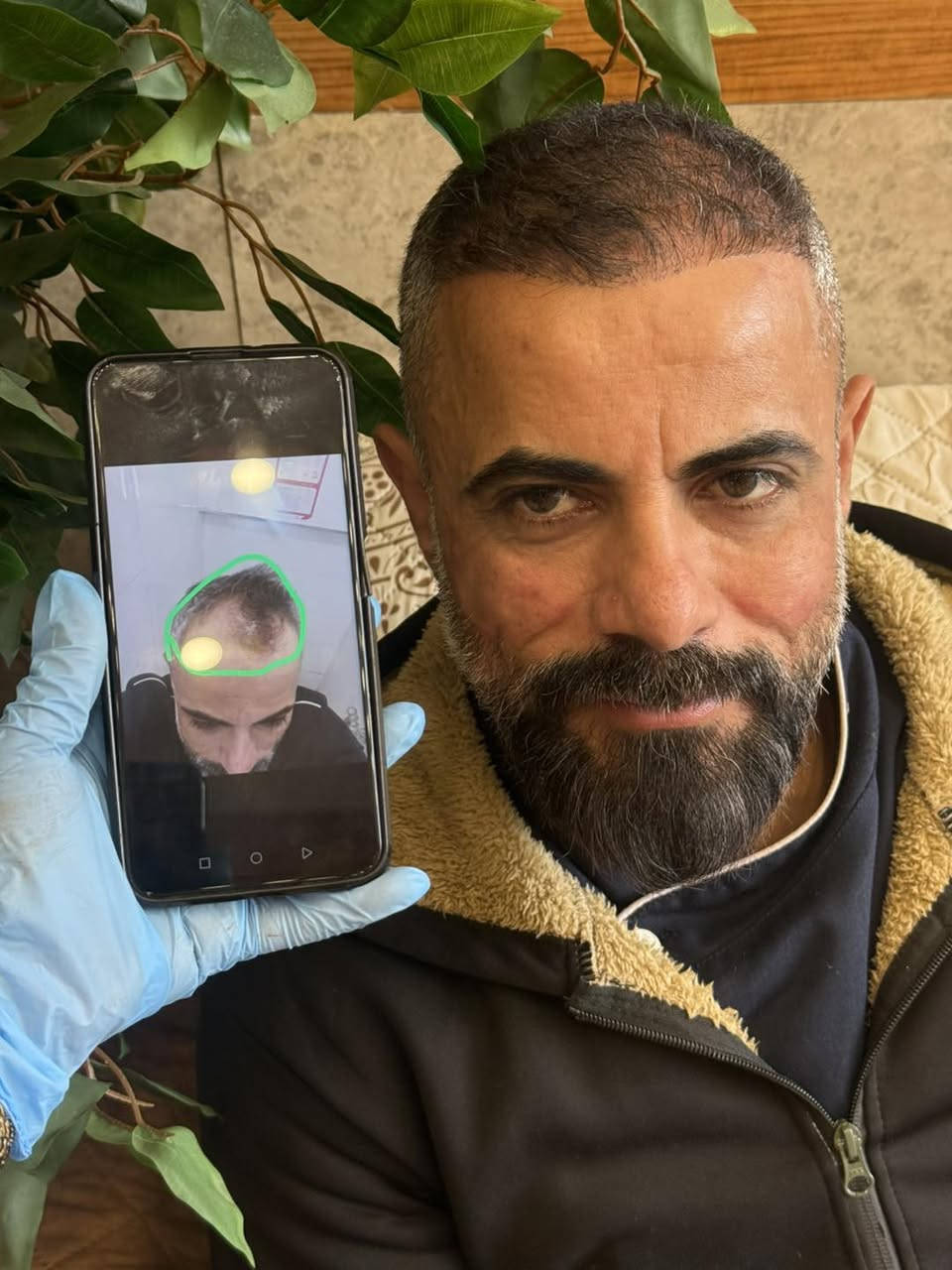 الناس دكول الاصلع ملك الساحه!
وانت صدكت ؟!!

#بخطوه وبقرار واحد تتخذه ترجع شبابك

(عياده الحارثيه لزراعه الشعر )

يوفرلك الخيار الأفضل لاستعادة شعرك الطبيعي والحل الدائم للتخلص من الصلع للأبد دون عناء أو ألم
✔️مظهر طبيعي وكثافة عالية
✔️ تحديد خط الجبهة الأمامي بجهاز الليزر
✔️ عملية زراعة الشعر بأعداد مفتوحة من البصيلات
✔️التخدير بدون ألم
✔️طاقم طبي محترف ذو خبره عاليه
✔️بدون تشوهات او ترك اي اثار بالمنطقه المانحه 
✔️ضمان مدى الحياة ع عمليتك 

#رجع_شبابك_واخلص_من_الصلع_ويانه 

اختياركم النه هو سر نجاحنا❤️🥇
 
 #فقــط_ب850_الـــف_دينار_عراقي 💯 

للحجز والاستفسار 
📥***********

بغداد - الحارثية
