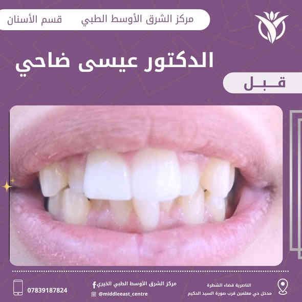 تقويم الأسنان 🤓😬
تقويم باسعار تنافسيه ب 650 الف فقط للفك الواحد 

أسنانكم رمز لكم ❤️
انتم بامان مع مركز الشرق الأوسط وبيد الدكتور#عيسى_ضاحي
لا تخلي ابتسامتك ناقصه 

العنوان ذي قار قضاء الشطرة مدخل حي المعلمين قرب صورة السيد الحكيم  مركز الشرق الأوسط الطبي التخصصي الخيري

الأستفسار أكثر الاتصال على الرقم او مراسلة الصفحه ***********⁩
