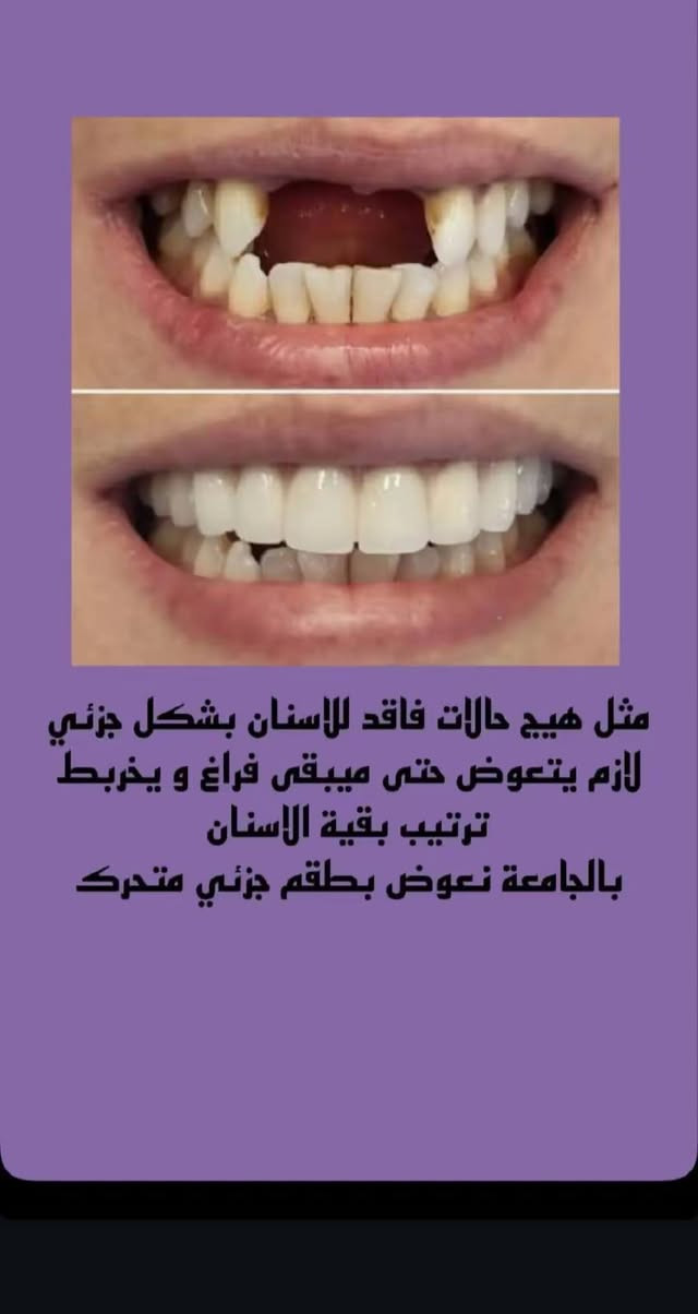 نعلن عن استقبال مراجعين للعلاج مجانــاً بالكامل وبدون أي أجور كشفية، مع استخدام أحدث الأجهزة وبإشراف مباشر من نخبة من أفضل أطباء الأسنان

🔹 خدماتنا تشمل:
✅ فحص شامل + خطة علاجية
✅ الحشوات التجميلية (البيضاء)
✅ تنظيف الأسنان + إزالة الكلس والجير
✅ القلع البسيط 
✅ طقم الاسنان الجزئي (3-6)اسنان

🦷 ونوفر لكم أفضل المواد العالمية:
✔️ حشوات تجميلية من Tokuyama – واحدة من أرقى وأقوى الشركات بالعالم
✔️ سمنتات ولاصقات عالية الجودة
✔️ مواد تعقيم آمنة وفعالة

📍 المكان: جامعة االمصطفى - شارع فلسطين
📞 للحجز والاستفسار على الخاص 

⚡️ لا تخلي الفرصة تروح عليك.. عالج اسنانك قبل رمضان🦷✨


**إذا كنت صاحب هذا الإعلان وتريد حذفه لأي سبب، رجاءا أرسل رسالة إلى الدعم الفني**