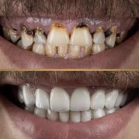 (((((((العلاج المجاني)))))) اي شخص عنده حالات(تسوس،قلع، تنظيف، طقم اسن...