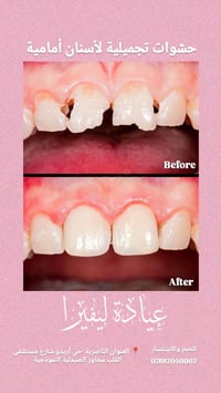 عيادة ليڤيرا • حشوات ضوئية • حشوات جذور