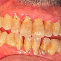 تنظيف أسنان • تلميع • المحمودية