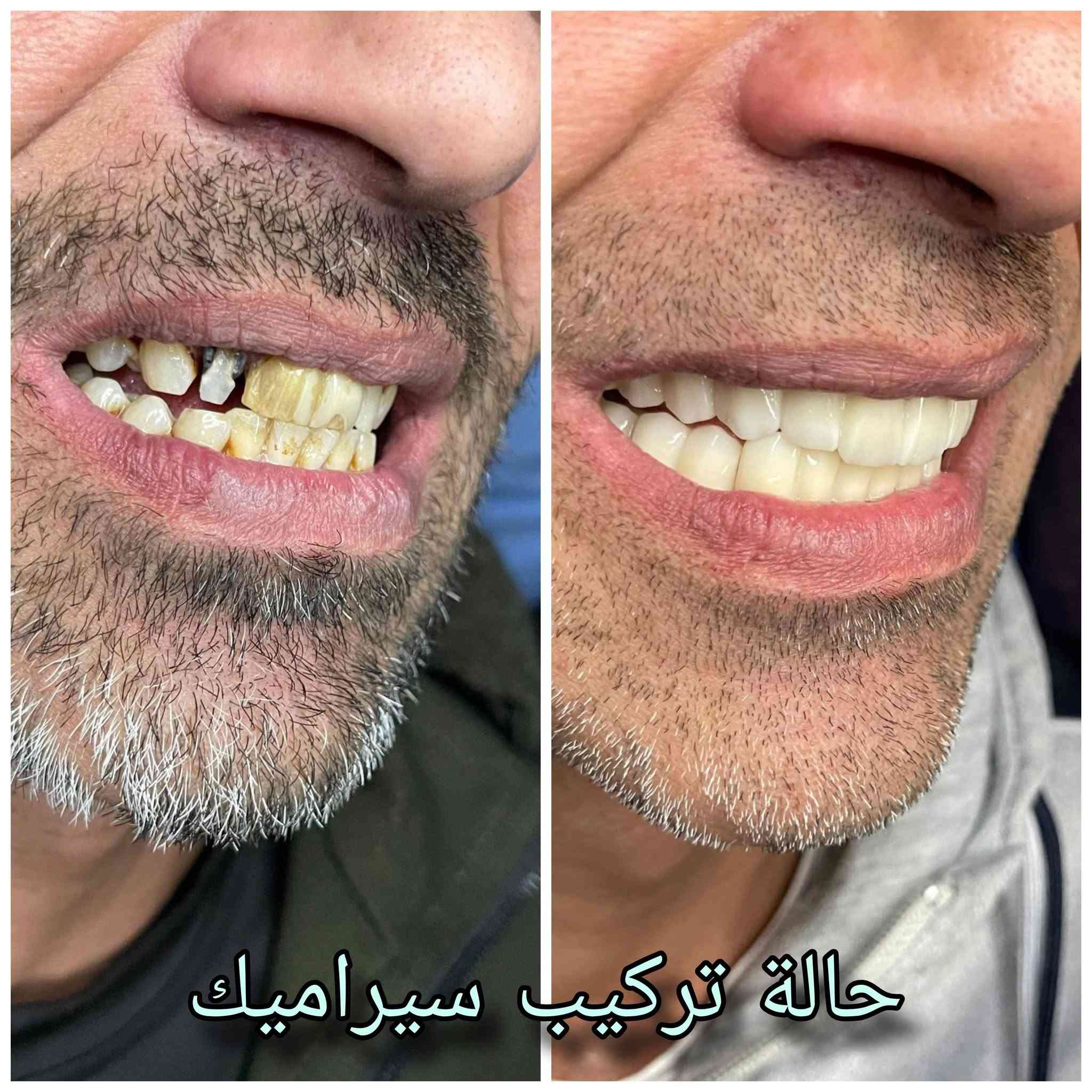 ✍️احجز موعدك واحصل على افضل النتائج الطبية
حالات تراكيب سيراميك وزاركون بأفضل ما يمكن .
خدماتنــــا الـتــــي تميزنــــا :🙋🏻‍♂️
‎- زراعة الأسنان الفورية والعادية.🇩🇪‎
- التلبيسات السنية (الزيركون والبورسلان).
‎- القشور الخزفية (emax) /الفينير ، ابتسامة هوليود /.
‎- جراحة وتجميل اللثة والفكين.‎- تقويم الأسنان بجميع أنواعه.
‎- نزع العصب والحشوات التجميلية والعادية.‎
- قسم خاص لعلاج جميع مشاكل الأسنان لدى الأطفال.‎
موقعنا : بغداد _ مدينة الصدر _ تقاطع الأورفلي _ العمارة البيضاء  _ مركز السلام الطبي التخصصي لكافة الاختصاصات الطبية
‎للاستفسار و حجز المواعيد أو للتواصل المباشر مع المختصين في المركز (واتس أو اتصال ) : ‎***********
‎‎نتشرف باستقبالكم وعلاجكم ونسعد بتقديم خدمة مميزة تليق بكم وبسمعتنا عندكم اوقات الدواممن الساعة ١٠ صباحآإلى الساعة ١٠ مساءآ
#اسنان #الحبيبه بغداد #العراق #طب #تجميل
