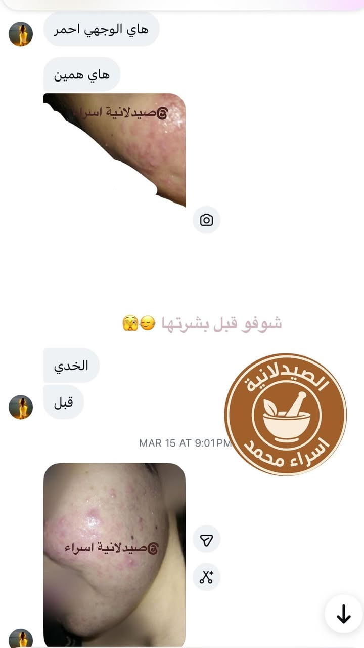 شوفوا شلون علاج بشرتها بأقل من  شهر رغم جان يحتاج الها روتين مدته شهرين بس شافت نتيجة ترضيها خلال شهر بس ❤️


**إذا كنت صاحب هذا الإعلان وتريد حذفه لأي سبب، رجاءا أرسل رسالة إلى الدعم الفني**