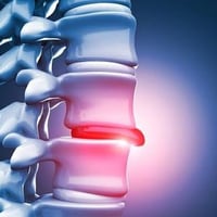 انزلاق غضروفي • سحب الفقرات • عيادة الأفق