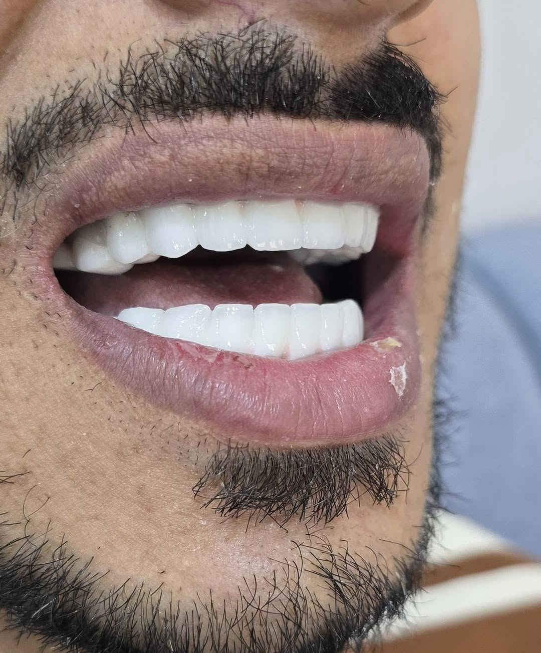 سلام عليكم ورحمة الله وبركاته
اسعد الله اوقاتكم 
وكل #عام_وانتم_بالف_خير
المختبر الابداع السوري  لصناعة الاسنان
و التعويضات السنية وتركيب الأسنان
وبأنسب الاسعار بجميع المحافظات
العراقية 
ملاحظة لدينا كادر يزور المريض للبيت ويتم العمل في المنزل 
للتواصل والحجز. ***********»꧁꧂«***********
