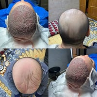 بعض حالات زراعة الشعر  تغطية الصلع كامل (vip)  العرض مستمر تكدرون تحجز...