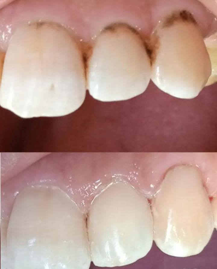 السلام عليكم 
اي شخص عنده تسوس قريب من اللثة أو بين الأسنان مثل الي بالصورة ويحب نشتغله حشوة تجميلية يراسلني على الخاص 
العلاج مجاناً وتحت إشراف اطباء أسنان اختصاص 
الموعد يوم الخميس المصادف ٢٦ 
العنوان : كلية النور ، طريق الشلالات ، مقابل دجلة ستي


**إذا كنت صاحب هذا الإعلان وتريد حذفه لأي سبب، رجاءا أرسل رسالة إلى الدعم الفني**