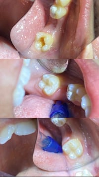 حشوة ضوئية تجميلية • عيادة زهراء الحيدري • الاسكان الثانية