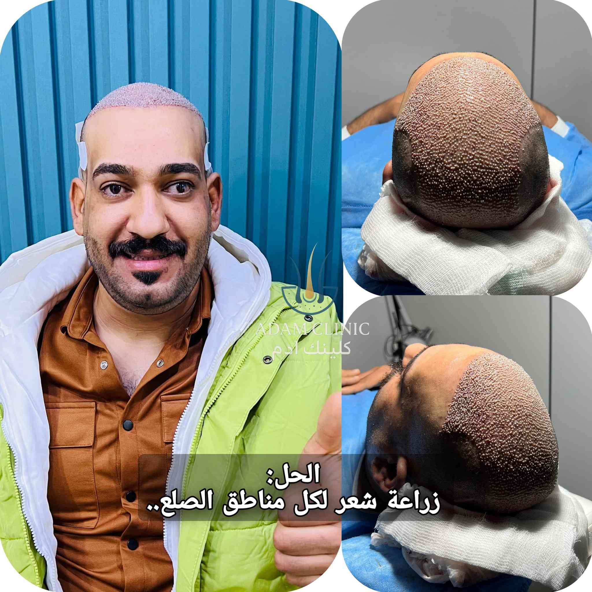 ✔️ تم تصميم خط أمامي طبيعي حسب شكل الوجه
✔️ توزيع البصيلات بكثافة مدروسة 
✔️ الشعر المزروع يبقى مدى الحياة 
📆 النتائج النهائية تبدي تبين من الشهر الرابع
🌱 الكثافة الحقيقية بين 6-10 أشهر

📩 إذا عندك نفس الحالة، تگدر تستفاد من الزراعة
راسلنا وخلي تقييمك يكون علمي مو عشوائي
 
📞 اتصال/ واتساب : ***********
📍بغداد - حي القادسية - قرب مستشفى اليرموك
