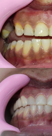 زركون ألماني • الفك العلوي • ضمان مدى الحياة