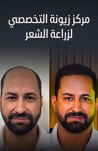✨✨ مع مركز زيونة التخصصي لزراعة الشعر ✨✨  احجز الآن دون تردد 💥  💫 مركز...