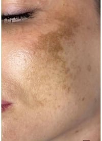 ديرما بن • عرض خاص • حلبجة